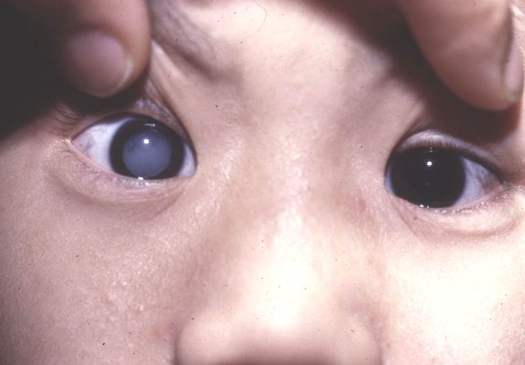 小兒白內障